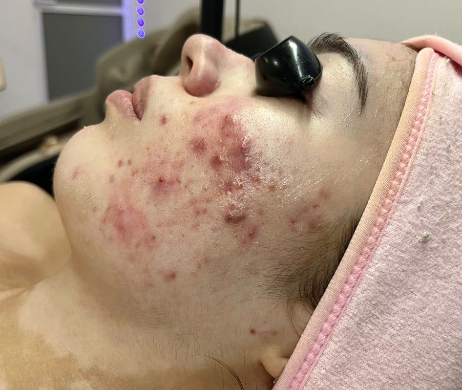 Antes: Facial para piel con tendencia acneica