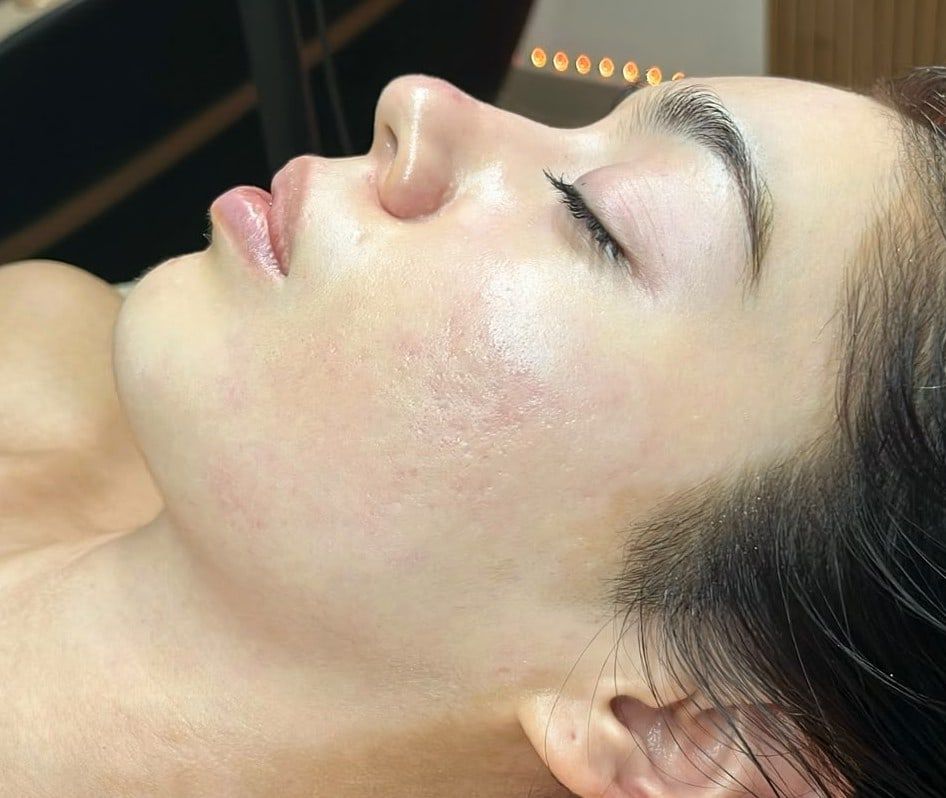 Después: Facial para piel con tendencia acneica