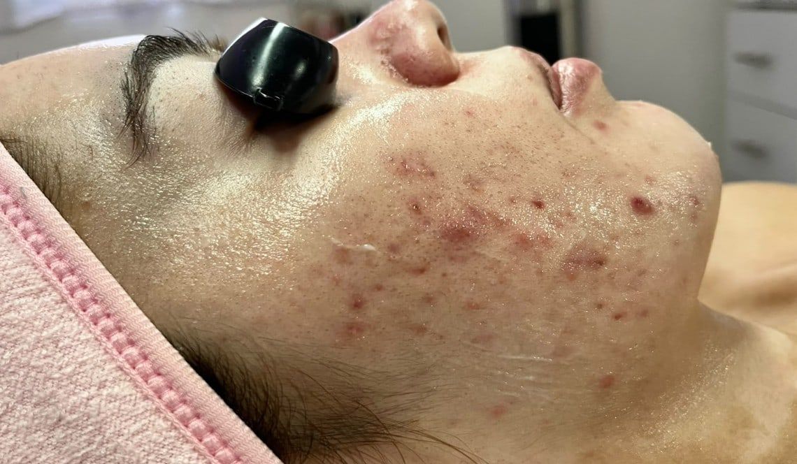 Antes: Facial para piel con tendencia acneica, caso 2