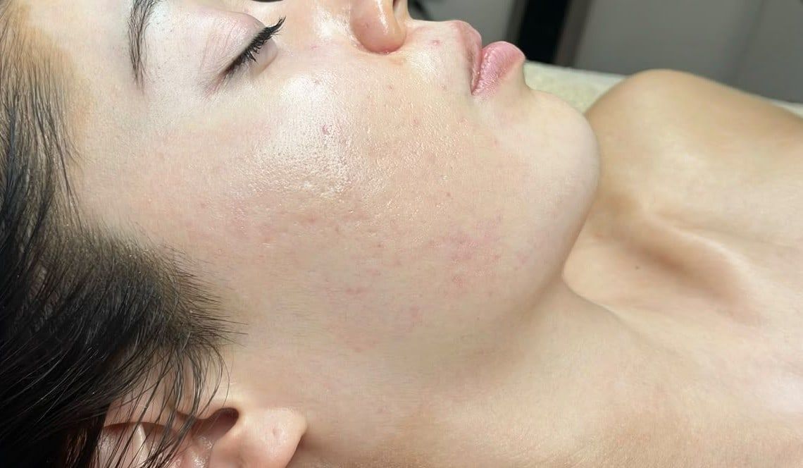 Después: Facial para piel con tendencia acneica, caso 2