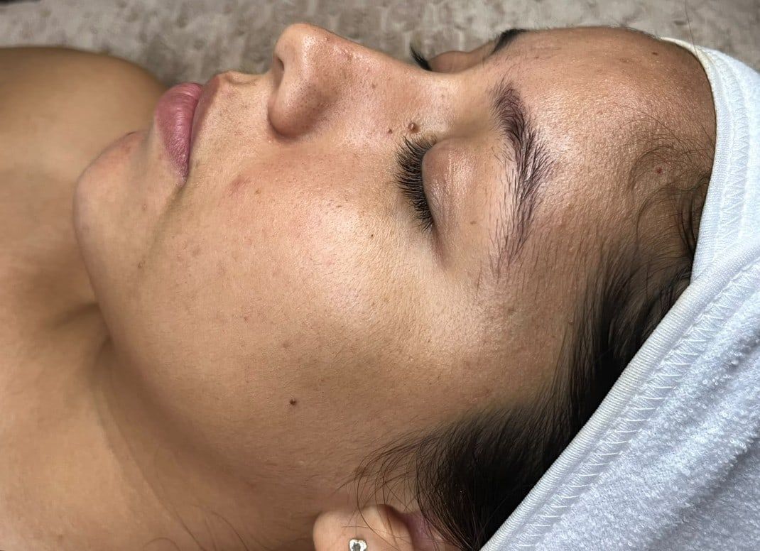 Antes: Dermaplaning