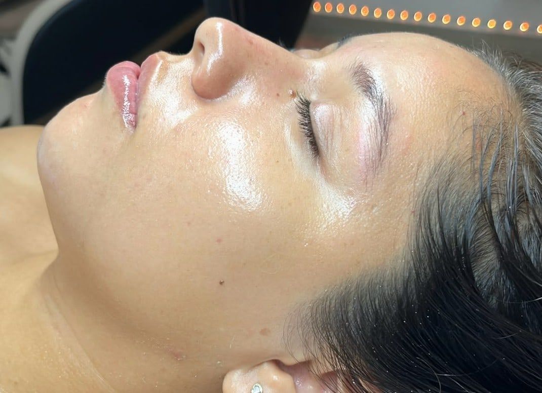 Después: Dermaplaning