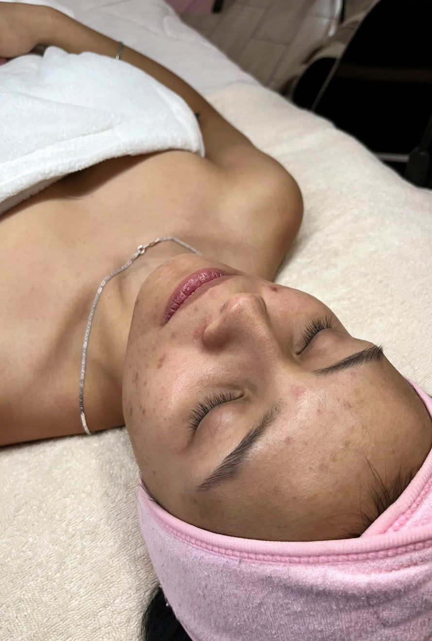 Antes: Facial despigmentante