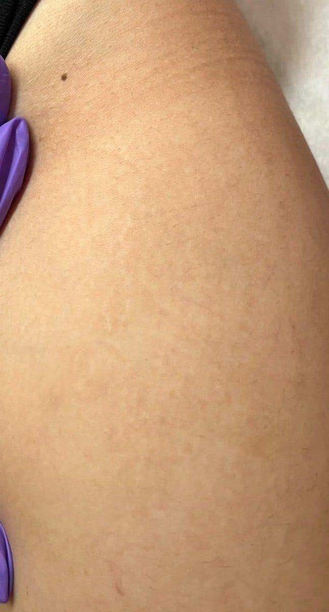 Después: Micropuntura brasileña en estrías