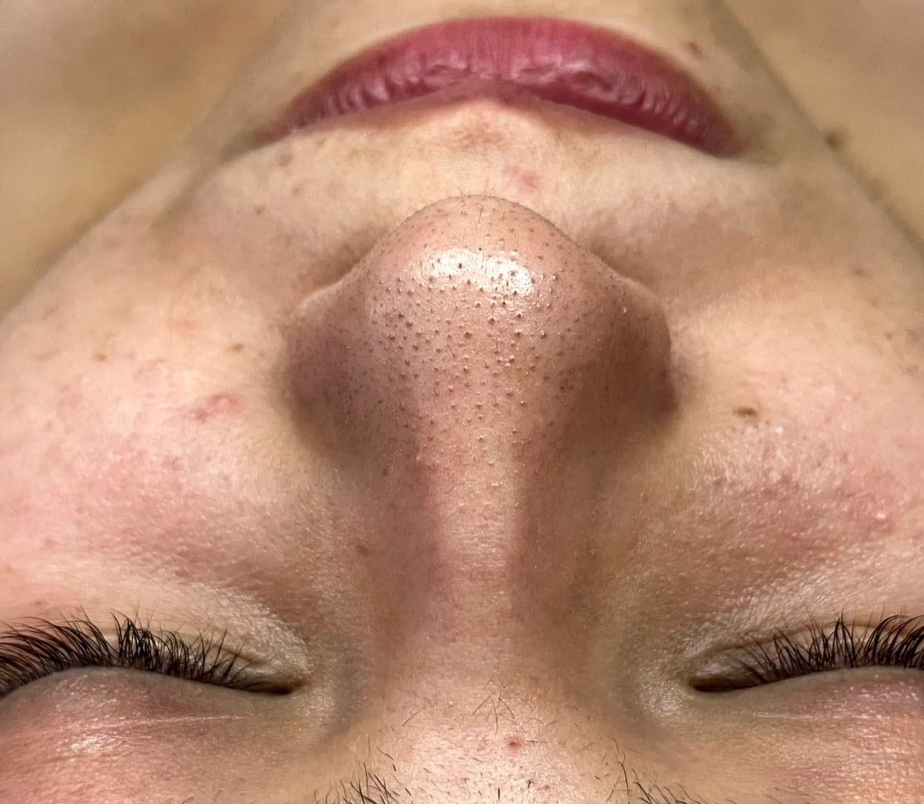Antes: Limpieza facial profunda