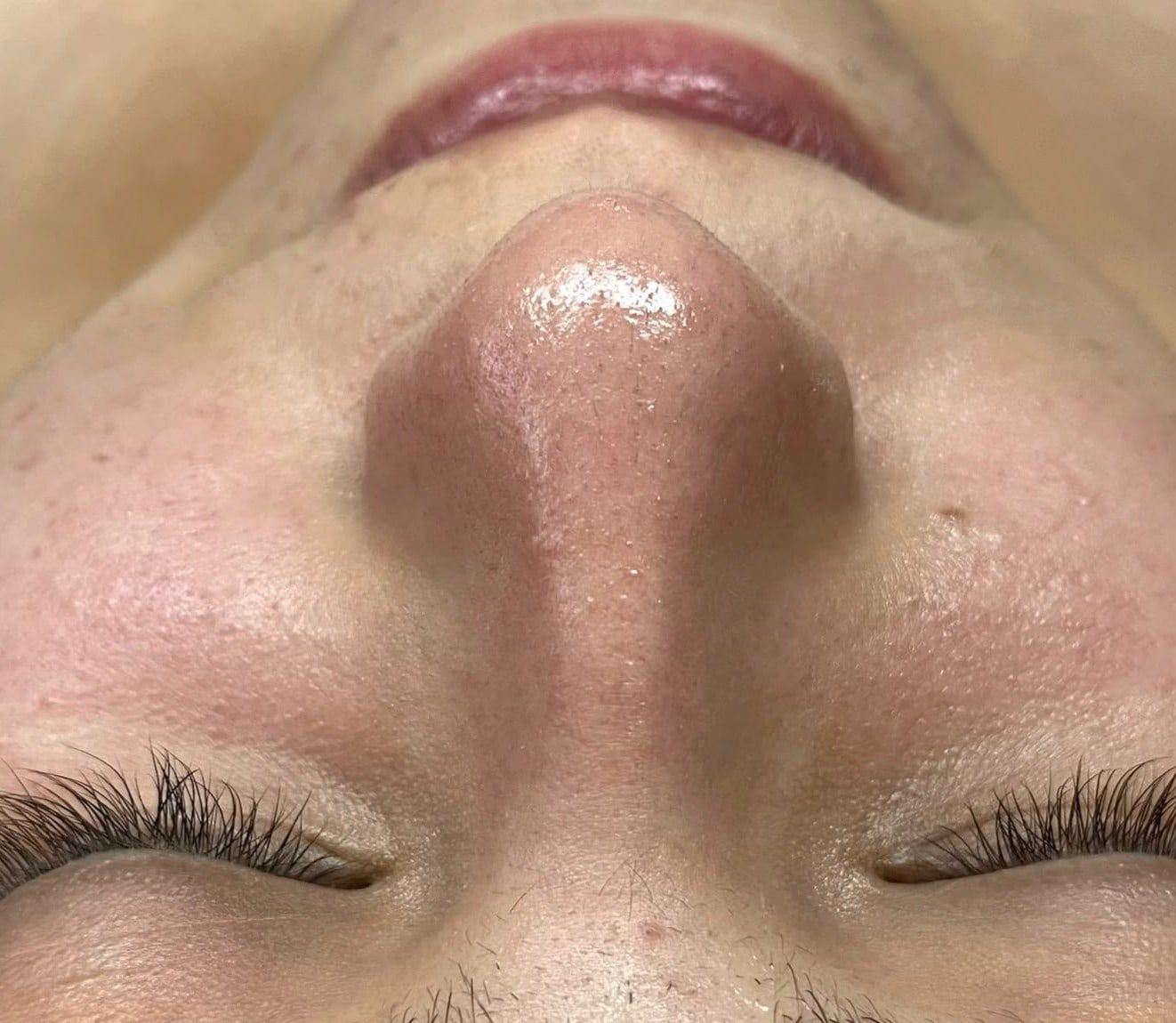 Después: Limpieza facial profunda